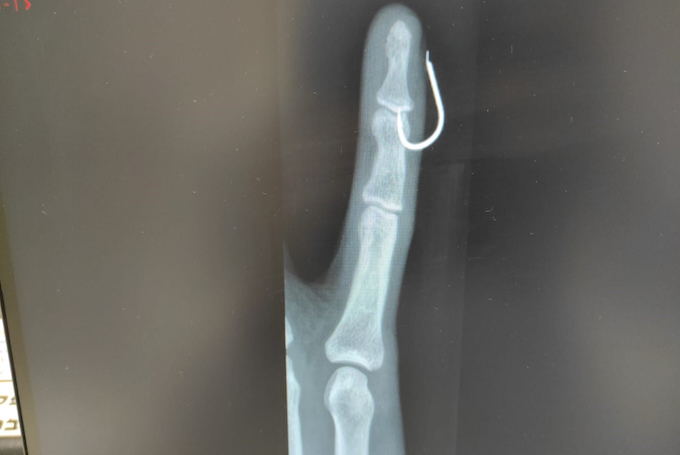 קרס דייג נשלפה מאצבעו של דייג במרכז לרפואה יועצת של כללית